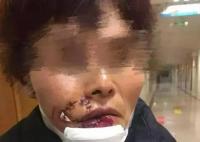 女子被狗撕碎左脸缝了500多针 原因竟是这样太可怕了
