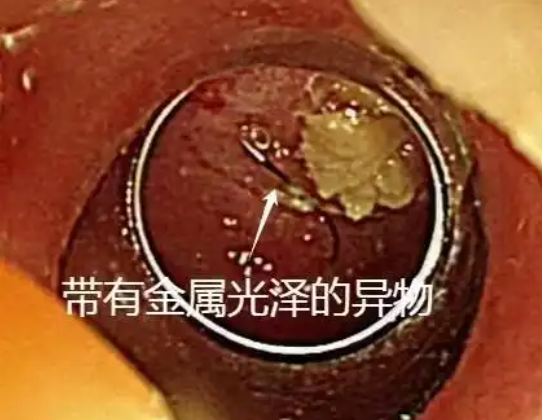 老人突发高烧拍胸片意外发现鱼钩 究竟是怎么回事？