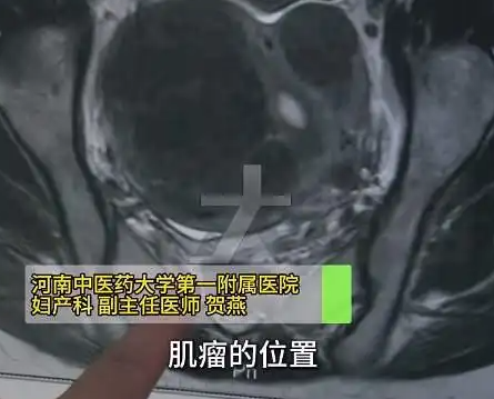 女子爱生闷气子宫里长了8个瘤 背后真相实在让人惊愕